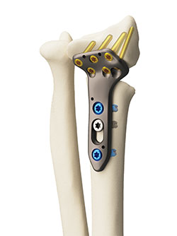 Custom-made osteosynthesis plate