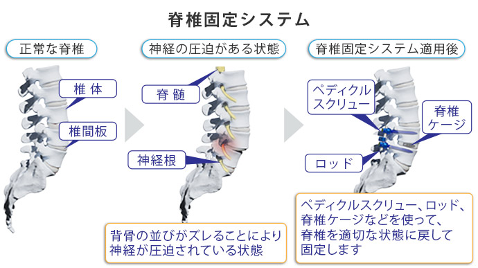 図：脊椎固定システム