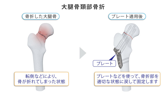 図：大腿骨頚部骨折